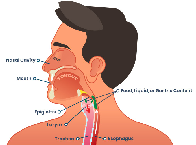 GLP-1s May Lead to an Increased Risk of Post-Endoscopy Aspiration Pneumonia